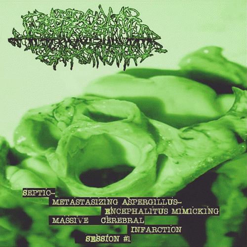 Trabecular Hepatocellular Carcinoma : Septic - Metastasizing Aspergillus - Encephalitus Mimicking Massive Cerebral Infarction Session #1